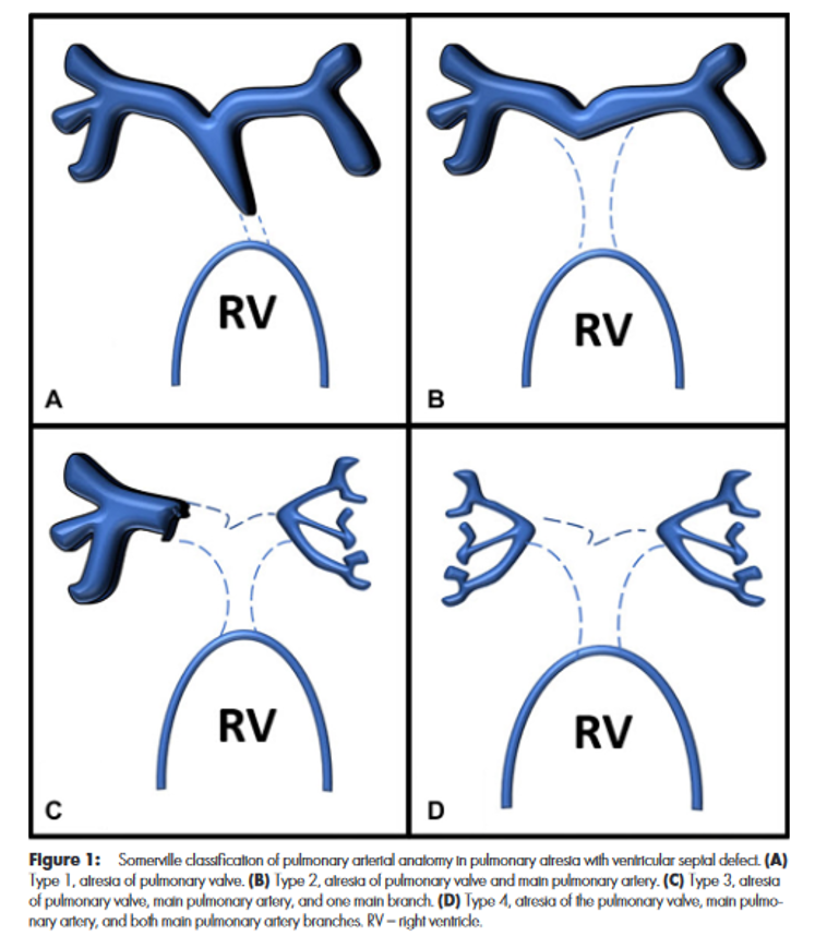 CardioCaribeMx's tweet photo. #MAPCAS
Colaterales Aorto-pulmonares
Clasificación
🧡Origen del vaso
🧡Comunicación
🧡Estenosis
Pronóstico
Calibre◀️2 mm Hipoperfusión
Calibre▶️3 mm HAP
Tratamiento
Unifocalización
Ligadura
Embolización
DOI 10.1148/ryct.210157
#nakata #McGoon #AP #Ao-Pulm https://t.co/okTyghtmUk