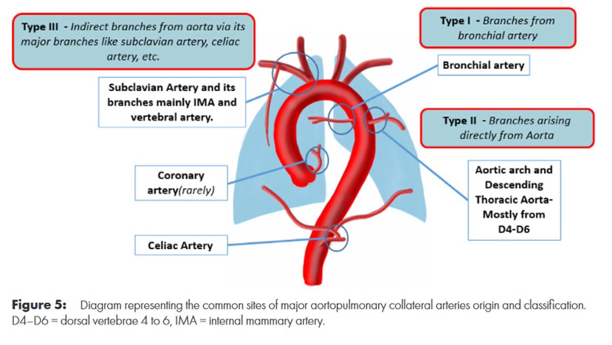 CardioCaribeMx's tweet photo. #MAPCAS
Colaterales Aorto-pulmonares
Clasificación
🧡Origen del vaso
🧡Comunicación
🧡Estenosis
Pronóstico
Calibre◀️2 mm Hipoperfusión
Calibre▶️3 mm HAP
Tratamiento
Unifocalización
Ligadura
Embolización
DOI 10.1148/ryct.210157
#nakata #McGoon #AP #Ao-Pulm https://t.co/okTyghtmUk