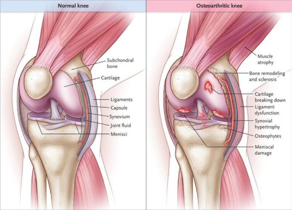 Omid_HopeUni's tweet photo. Osteoarthritis-related synovial joint changes👇

▪️ muscle atrophy
▪️ bone remodelling &amp; sclerosis 
▪️ cartilage break down
▪️ ligament dysfunction
▪️ synovial hypertrophy 
▪️ osteophytes
▪️ meniscal damage

#joint #arthritis #OA

https://t.co/yb03xITbla https://t.co/0zkOgvA31q