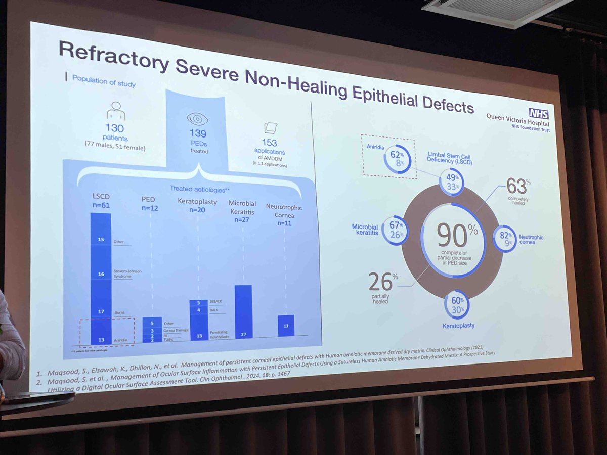“ Sutureless AMT are a promising tool for specialised care - potentially prevent Aniridia-Associated OSD
progression” conclusion by prof. Andrew Hopkinson, University of Nottingham, UK #europeananiridiaconference2024 #amnioticmembrane #aniridia
