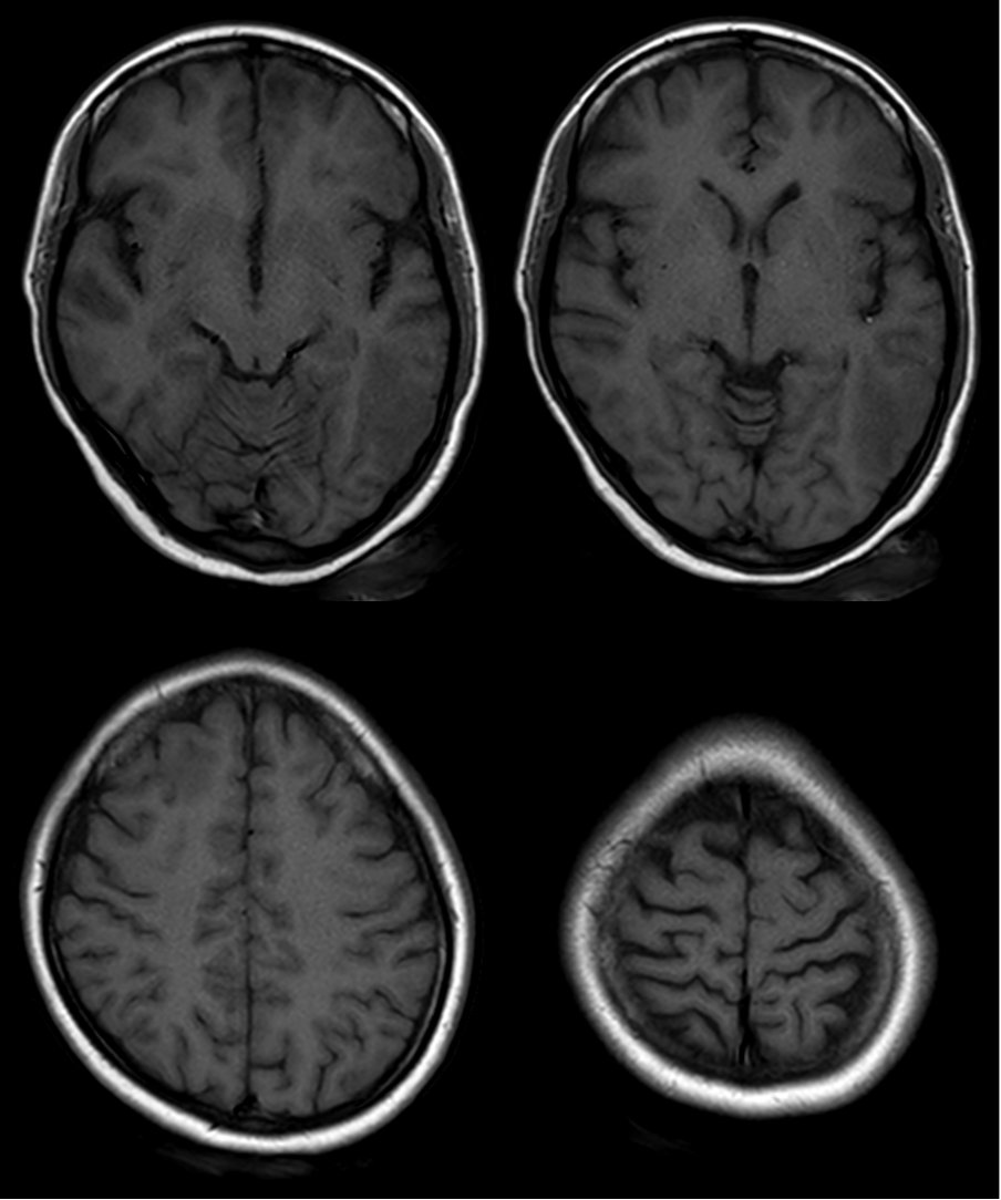 nirmalregency's tweet photo. 31♀ 8M h/o intermittent headaches. Normal CT head 6M earlier. Presented to ER w/ severe headache. MR ordered. No diffusion restriction. 
1️⃣T2/FLAIR👇 multiple WM peripherally located hyperintensities. 
2️⃣T1 hypo👇
#neurotwitter #NeuroX #MedTwitter #MedX #Neurology #FOAMmed 🧵 https://t.co/CWFu7U9co5