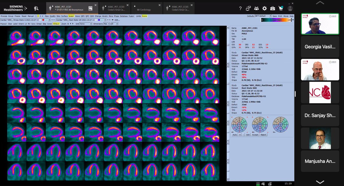 gmvasilakis's tweet image. Continuing with our #MPI case highlights - Dr. Arumugam shares a great case where it is important to examine the flow data by the vascular territory AND the segmental flows. 

Segmental flows ➡️➡️ Patterns of abnormality  

#CVNuc @MyASNC @ParthibanArum18