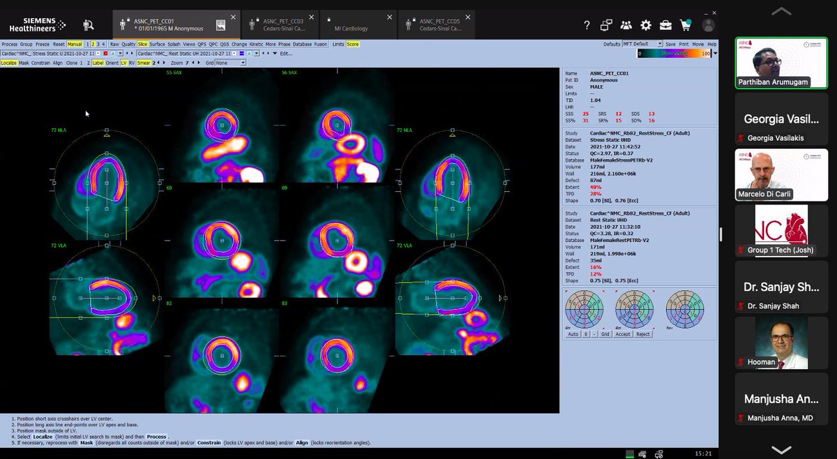 gmvasilakis's tweet image. Continuing with our #MPI case highlights - Dr. Arumugam shares a great case where it is important to examine the flow data by the vascular territory AND the segmental flows. 

Segmental flows ➡️➡️ Patterns of abnormality  

#CVNuc @MyASNC @ParthibanArum18
