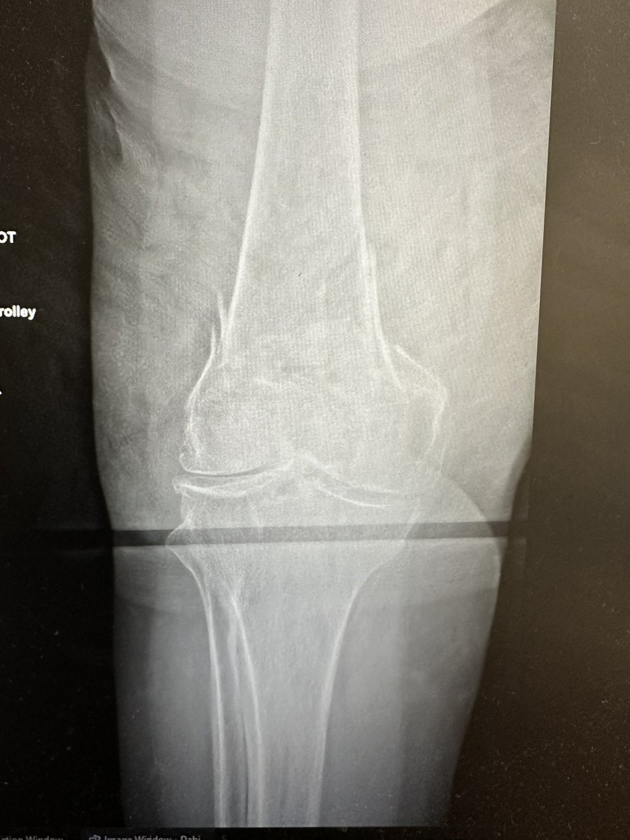 SurgeonKnee's tweet photo. Opinions and thoughts appreciated. 
76, mild dementia, isolated injury. Needs to be FWB post op. Retrograde Nail/plate combination or Distal Femoral replacement? https://t.co/KSHTRE2zza