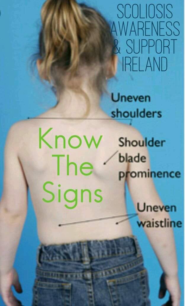 June is Scoliosis Awareness month
Screen your child today #knowthesigns
Let's raise awareness together 
#scoliosisawarenessmonth #knowthesigns #SpreadTheWord