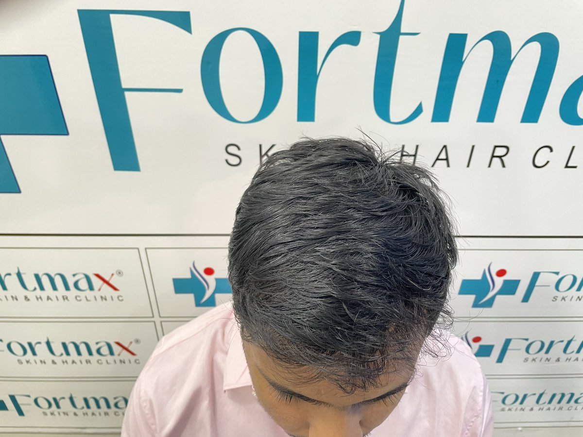 fortmaxclinic's tweet photo. #FortMaxClinic #HairTransplant #HairRestoration #HairLossSolution #ConfidenceBoost #EMIOffer #HairRevival #NewYou #HairTransformation #SelfAssurance #HairCare #BeConfident #HairGoals #ModernSolutions #HairTransplantdoctor #HairTreatment #Hairfall #Hairgrowth #Hairsolution https://t.co/PkbexjiNoK