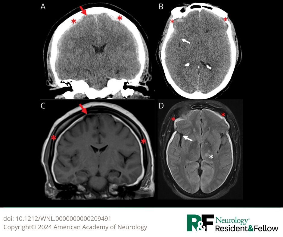 Pearls &amp; Oy-sters: What Came First, the Bleed or the Fall? bit.ly/3wXFz07

#NeurologyRF #NeuroTwitter