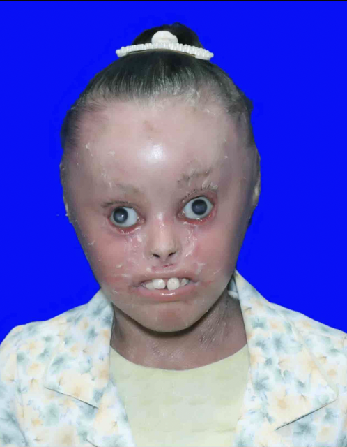 gofund.me/0732b1bf Ghufran is a disabled 8-year-old in Gaza. She has a life-threatening skin disorder called icthyosis. She also has ectropion, meaning her eyelids are turned inside out bc of her tight skin. She can't blink or close her eyes. More about Ghufran, continued