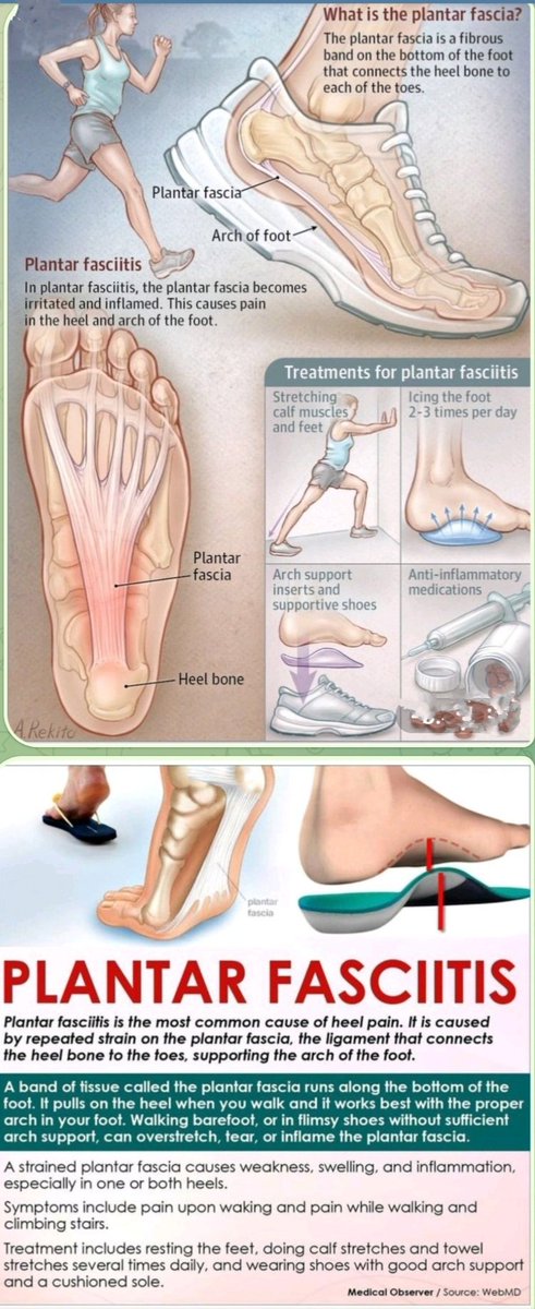🔴PLANTAR FASCIITIS occurs due to degenerative irritation at origin of plantar fascia.
It's more seen in people with :
-Foot arch problems (both flat feet &amp; high arches)
-Run long distances
-Obese
-Having a tight Achilles tendon
-Wearing shoes with poor arch support or soft soles