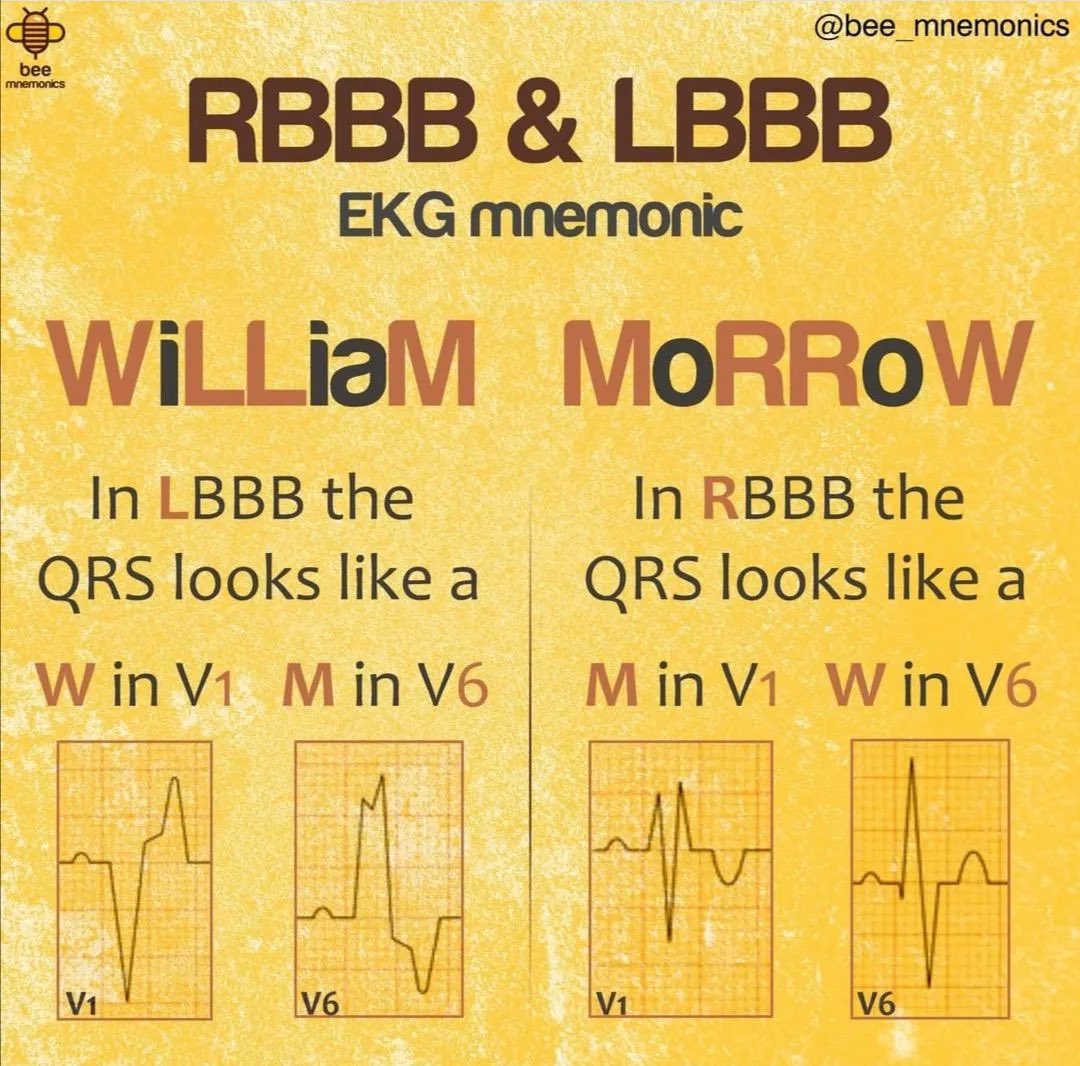 Easy way to remember LBBB &amp; RBBB.