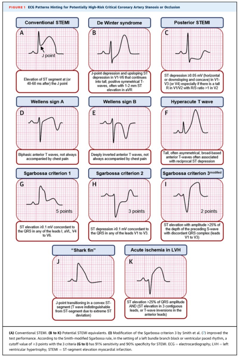 Siempre es bueno recordar patrones de ECG para sospechar infarto agudo! Reperfusion precoz!