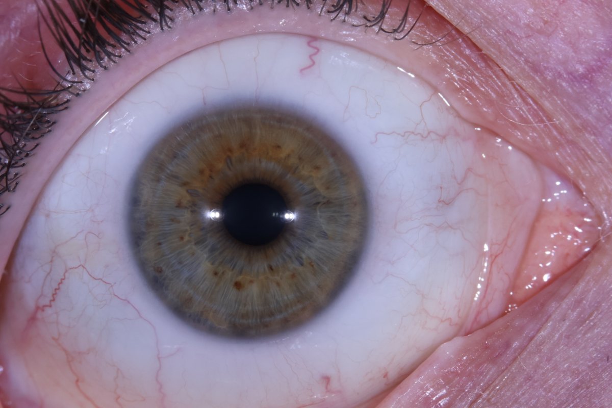 irislabltd's tweet photo. Capture every detail of the Sclera (whites of the eye).
The sclera gives more short-term information... what has been happening with a person in the last few days/weeks/months. 

Clue: Where are the red blood vessels pointing to?

https://t.co/hNO1OXZavM
#iridology
#irislab https://t.co/6upEkR6Imb