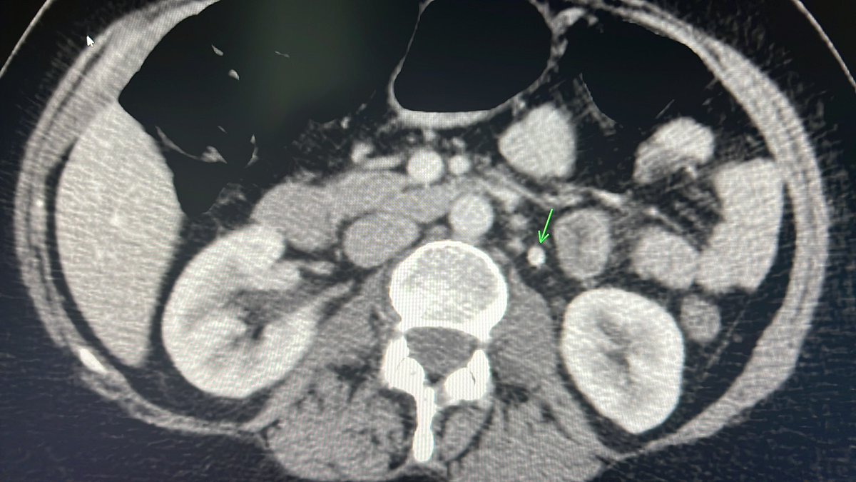 ChengaziMD's tweet image. Ins co deny #PeVD tx due to lack of Dx criteria like what exists for peripheral superficial #veins 

Asymmetric early opacification of the LGV from LRV is CT evidence of #reflux and should be correlated w/ symptoms for tx. @SIRspecialists can we formalize this into dx criteria?
