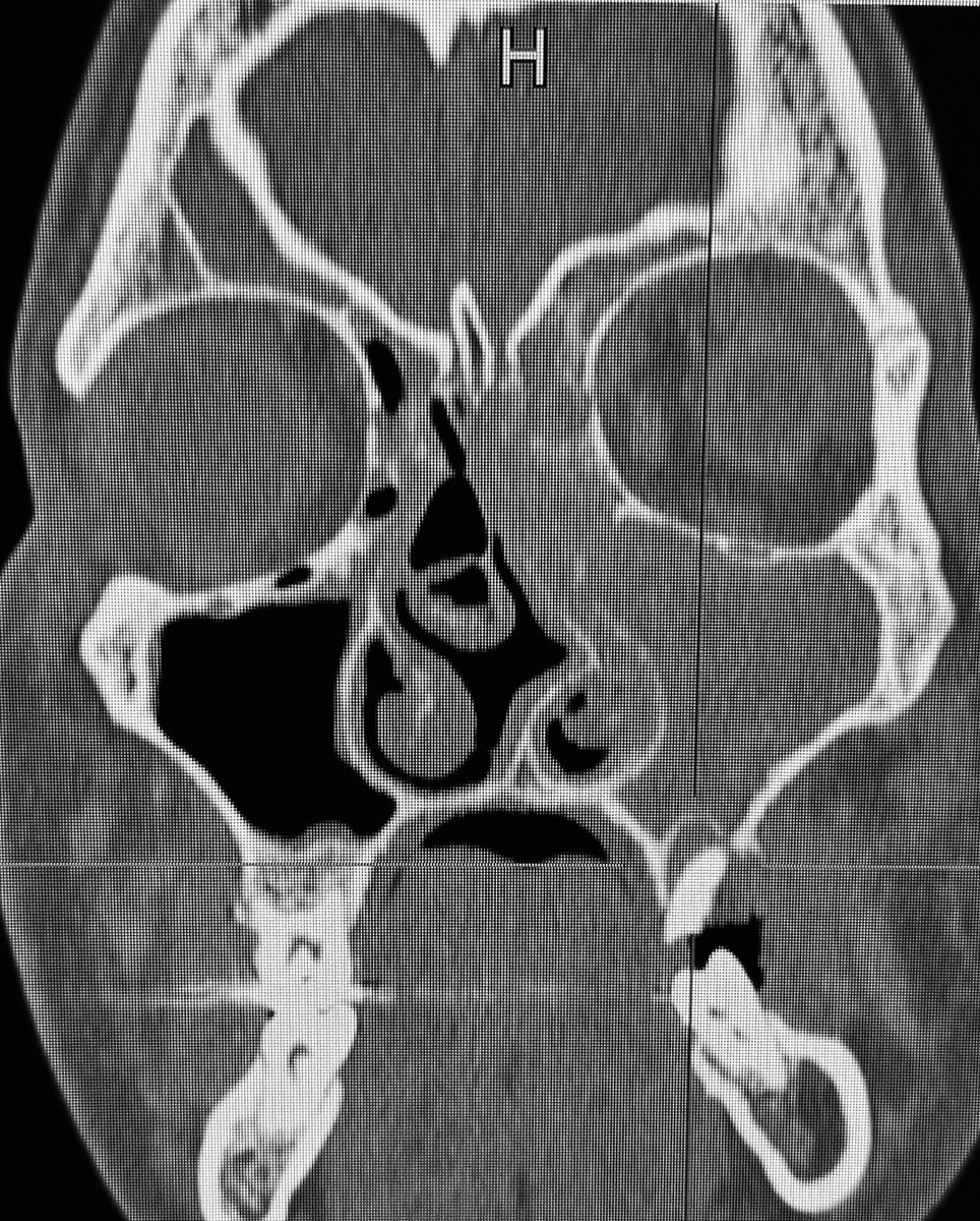 MartaKwiat_ska's tweet photo. Severe #septal deviation, acute inflammatort sinusitis combined with #periapical lesion.
Smells like #ODS?
Adding preseptal #orbital cellulitis
Pt staged for surgery but… did not consent🤔
Treated with abx and steroids so far, expected results…?
@JohnCraigNose @ent_ams https://t.co/QwwQrBHt85