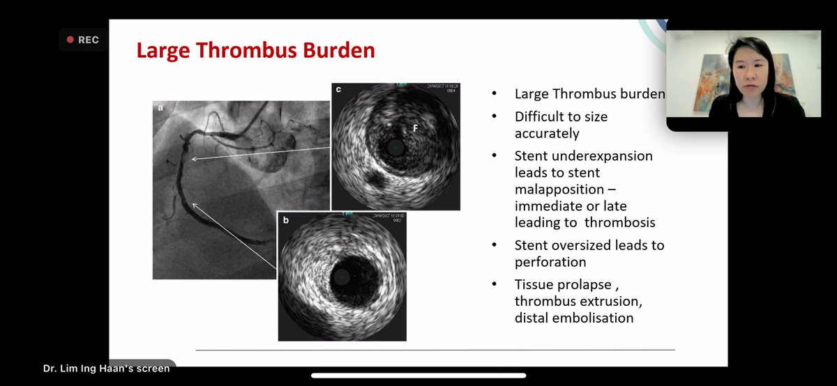 mirvatalasnag's tweet photo. @DrSaritaRao2 Indian experience
@inghaanMD IC imaging in STEMI
@APSIC6 #WIN_APSIC https://t.co/2QBqLzb6RS