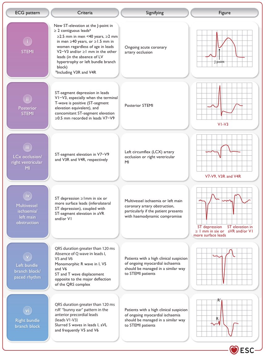 #ECG abnormalities that may require immediate reperfusion therapy (primary #PCI) 💉

Mandatory pearl‼️
doi.org/10.1093/eurhea…
