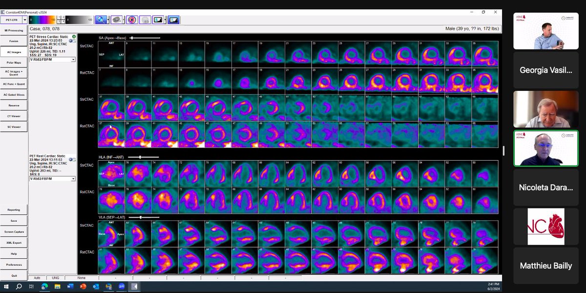 gmvasilakis's tweet image. ⭐️Finishing up our #MPI session with Dr. Bateman and Dr. Calnon sharing cases involving #CAD and #CardiacTransplant

#CVNuc @MyASNC #ThinkPET