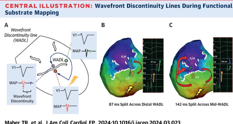 Roy Chung (@rchung_ep) on Twitter photo Another #VT approach by Utilizing WADL at (30%) to elucidate LOB by <a href="/TimothyMaherMD1/">Timothy Maher, MD</a> <a href="/Davilandre/">Andre d’Avila</a> jacc.org/doi/full/10.10… #Epeeps Another #VT approach by Utilizing WADL at (30%) to elucidate LOB by <a href="/TimothyMaherMD1/">Timothy Maher, MD</a> <a href="/Davilandre/">Andre d’Avila</a> jacc.org/doi/full/10.10… #Epeeps