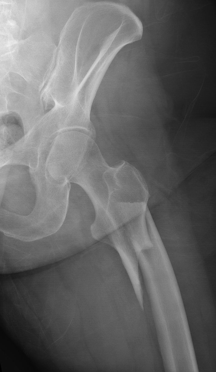 UW MSK Imaging & Intervention (@uw_mskrad) on Twitter photo #CaseOfTheWeek...End🎉
📢✅Answer for Case #20: Bisphosphonate subtrochanteric fracture (atypical)
Have a great week and happy June!!🥳🎉
#FOAMrad #RadEd #MedEd #OrthoEd #OrthoTwitter <a href="/ssr_rwg/">SSR_RWG</a> <a href="/UWRadRes/">UWisconsin Radiology Residents</a> <a href="/otaeducation/">OTA Online</a> #CaseOfTheWeek...End🎉
📢✅Answer for Case #20: Bisphosphonate subtrochanteric fracture (atypical)
Have a great week and happy June!!🥳🎉
#FOAMrad #RadEd #MedEd #OrthoEd #OrthoTwitter <a href="/ssr_rwg/">SSR_RWG</a> <a href="/UWRadRes/">UWisconsin Radiology Residents</a> <a href="/otaeducation/">OTA Online</a>