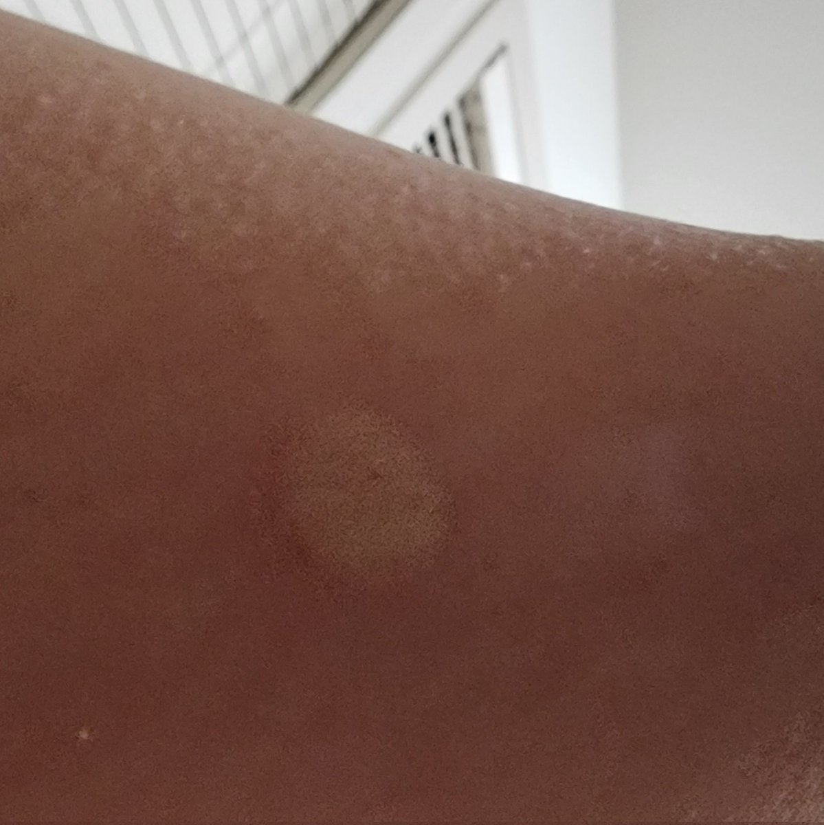 EnhaFish's tweet image. Ugh, I really hate getting bug bites💀