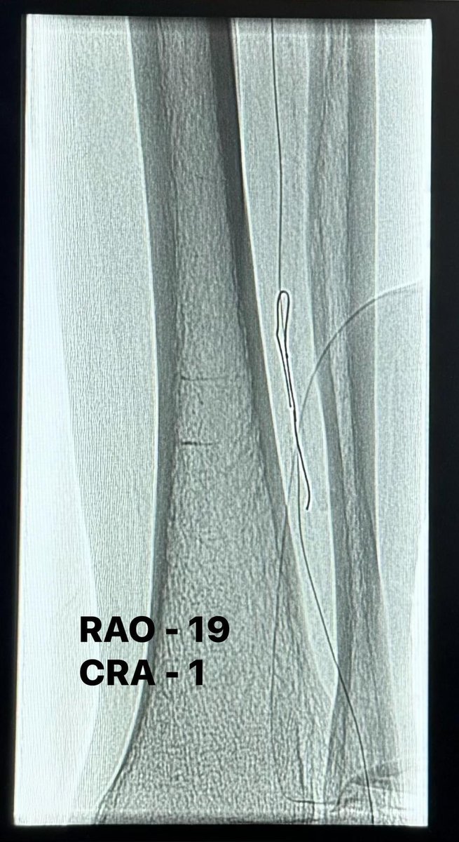 drAliyor's tweet photo. 🇬🇧 Remember! X-ray angiography creates 2D projection images of the complex 3D/4d anatomy of arteries, multiple images should be collected by placing X-ray detector in different positions to ease assessment!
Intervention Uzbekistan #angiography #Angioplasty #peripherial #CathLab https://t.co/VNWGGyYLq6