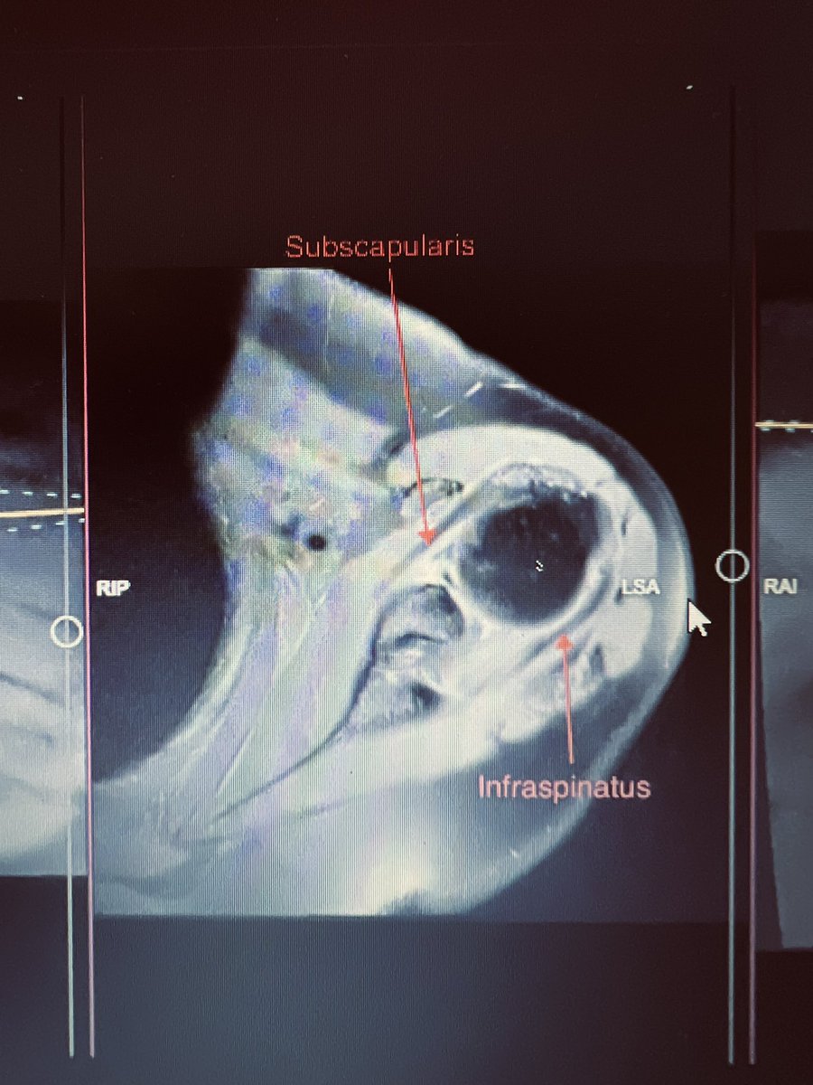 Al-Asano 🇵🇰 (@_mer119) on Twitter photo Incredible start to the day with learning about MSK imaging and going through very interesting cases! As someone who didn’t get much good anatomy or imaging teaching in med school due to Covid I really have enjoyed myself so far 🙌🏼
<a href="/ExerciseIrfan/">exerciseirfan</a> <a href="/DocLasker/">Imran Lasker</a> <a href="/MSKPlaybook/">MSK Playbook</a> Incredible start to the day with learning about MSK imaging and going through very interesting cases! As someone who didn’t get much good anatomy or imaging teaching in med school due to Covid I really have enjoyed myself so far 🙌🏼
<a href="/ExerciseIrfan/">exerciseirfan</a> <a href="/DocLasker/">Imran Lasker</a> <a href="/MSKPlaybook/">MSK Playbook</a>