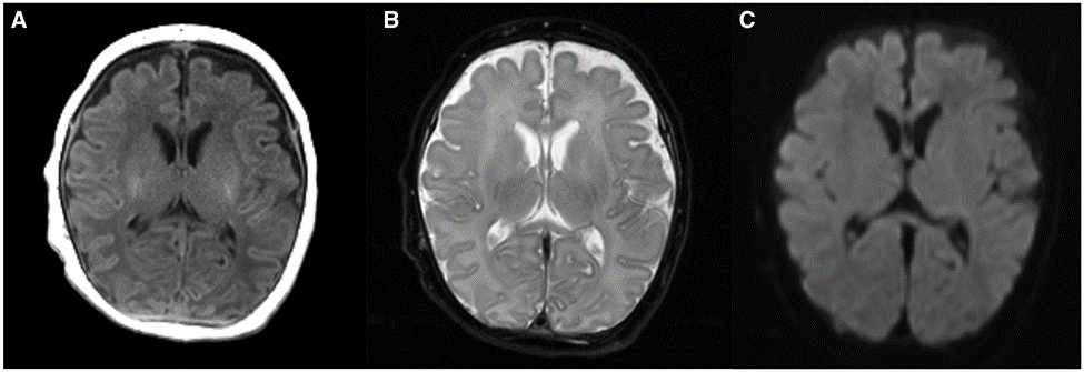 BJR_Radiology's tweet photo. Review
MRI predictors of long-term outcomes of neonatal hypoxic ischaemic encephalopathy: a primer for radiologists
https://t.co/fAiCJJTVa4
#Radiology https://t.co/JT6HZ1t7uR