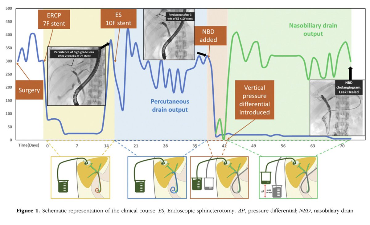 Thank you #GITwitter for all the excellent inputs🙏🙏

Post-op peripheral bile leaks persisting after ERCP can be complex

Can try FCSEMS, but usually doesn’t work

Surgical re-exploration works, but may be morbid

We report a simple technique here…

igiejournal.org/article/S2949-…