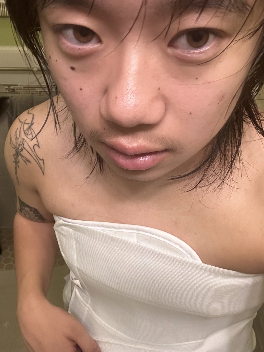 yuzupomuu's tweet image. #recoveryupdate Somehow despite being unshowered and greasy hair my skin has gotten less broken out..curious to know how that works..Hopefully going to get drains out in a day or so..Excited to fix my posture