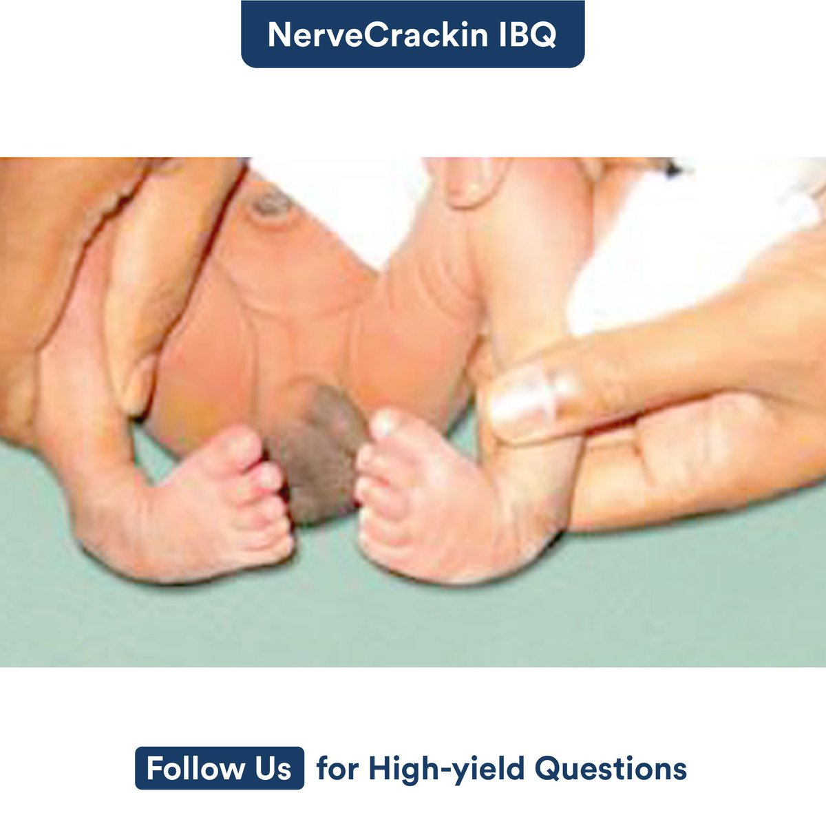 Which of the following statements regarding the condition shown in the image is incorrect?

A. Kite’s angle is less than 35 degrees 
B. Small heel 
C. Plumbline test is a screening test 
D. Inner side of foot is convex with dimples 

#DigiNerve #IBQ #NerveCrackin #QuizTime #heel