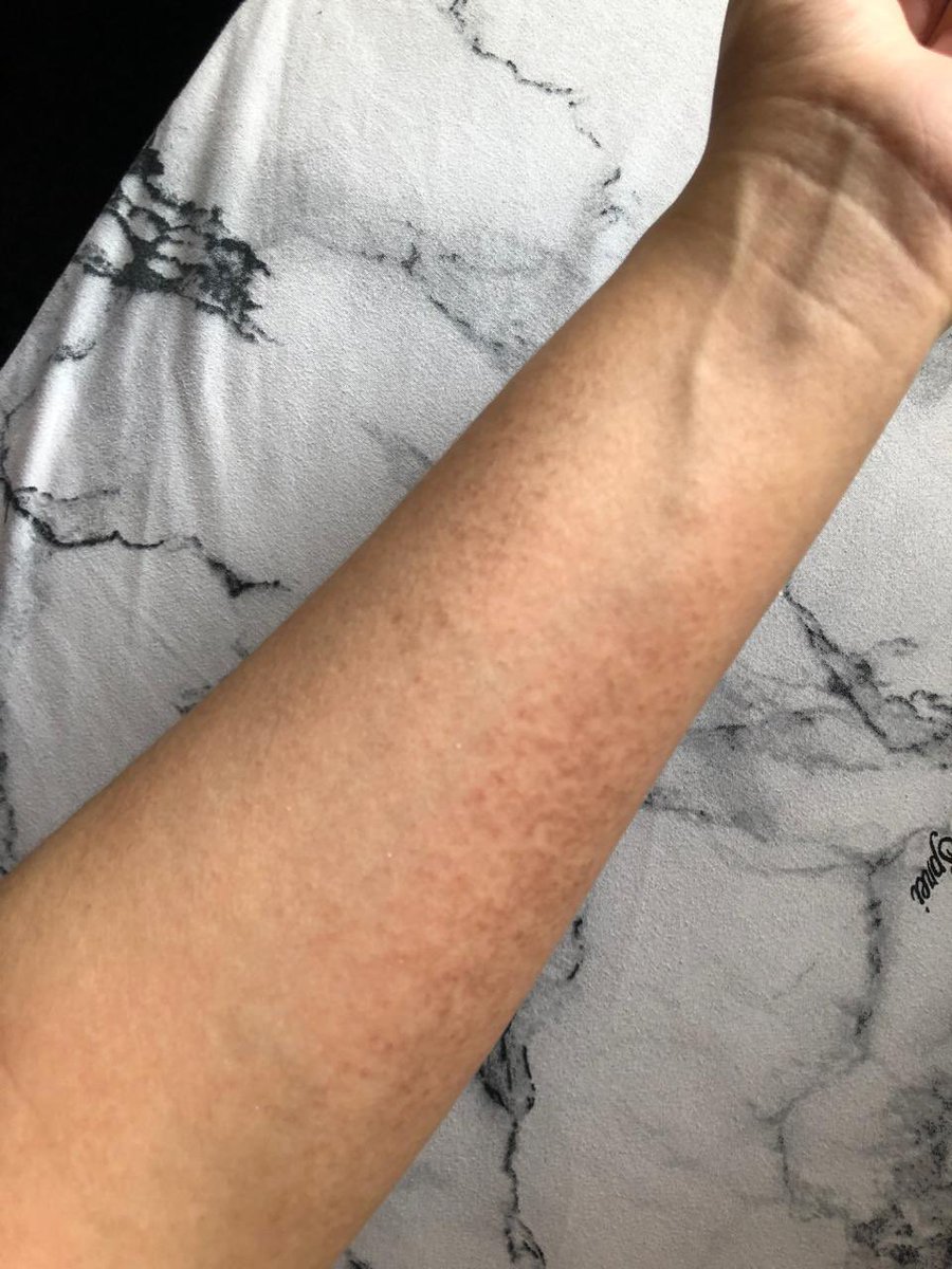 MelindaAghnia's tweet image. Pemakaian gak ada 2 bulan aja mendingan banget, ini awalnya kering gitu terus gatel jadinya merah banget ditambah menggelap