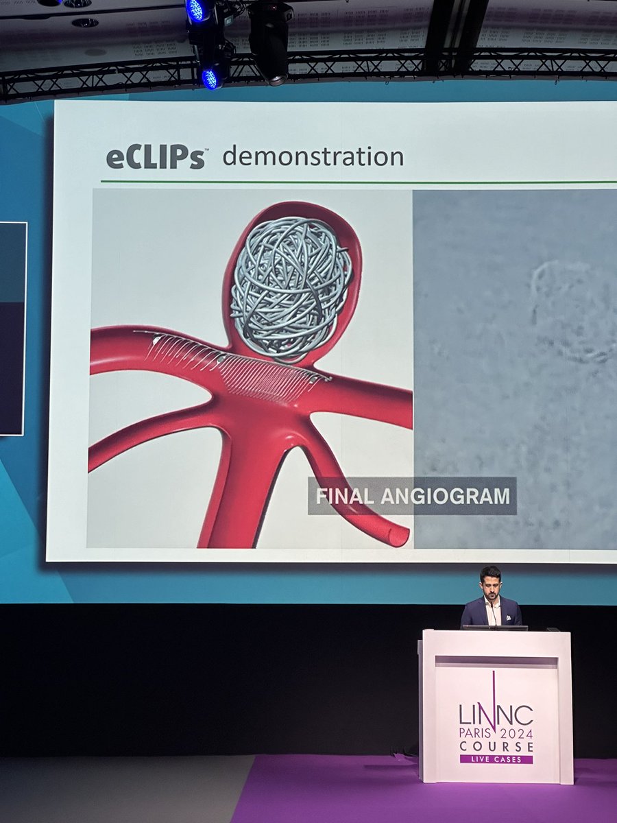 #Innovation
•"Is the act of working through all the obstacles and problems of turning a creative idea into a success". Dr Tom Marotta 🇨🇦 #aneurysm #newdevices 
<a href="/LINNConline/">LINNC online 🧠</a> <a href="/neurofox/">Rodrigo Rivera</a>
@ipagiola
<a href="/DanielVelaMD/">Daniel Vela-Duarte, MD</a>
<a href="/DoctorGaldamez/">Mario Martínez-Galdámez</a>
<a href="/sujijantaratMD/">Nanthiya Sujijantarat, MD</a>