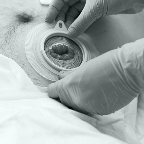 @ACPGBI (@acpgbi) on Twitter photo Join us on 3 June for a webinar on 'Stomas in the Emergency Room' presented by the EGS Sub-Committee
Real cases, expert discussion, & practical solutions for emergency surgery dilemmas
Don't miss it!
👉bit.ly/ACP-Stomas-in-…
<a href="/slade_dom/">Dominic Slade</a>
<a href="/Richard_J_Guy/">Richard Guy</a>
<a href="/NatashaRolls1/">Natasha Rolls RGN (@luckywoman.bsky.social 🦋</a> Join us on 3 June for a webinar on 'Stomas in the Emergency Room' presented by the EGS Sub-Committee
Real cases, expert discussion, & practical solutions for emergency surgery dilemmas
Don't miss it!
👉bit.ly/ACP-Stomas-in-…
<a href="/slade_dom/">Dominic Slade</a>
<a href="/Richard_J_Guy/">Richard Guy</a>
<a href="/NatashaRolls1/">Natasha Rolls RGN (@luckywoman.bsky.social 🦋</a>