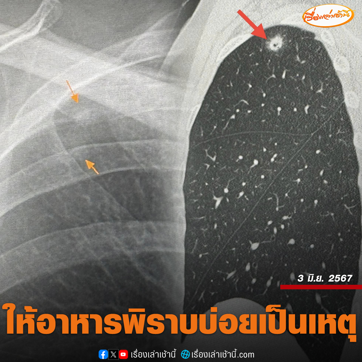 MorningNewsTV3's tweet photo. ใจดีเป็นเหตุ! หมอมนูญ แชร์อุทาหรณ์ ผู้ป่วยหญิงวัย 52 แข็งแรง-ไม่สูบบุหรี่ แต่ตรวจพบก้อนในปอด ซักประวัติพบให้อาหารนกพิราบประจำ จึงหายใจเอาสปอร์เชื้อราจากมูลพิราบเข้าไป จนปอดอักเสบเป็นก้อนที่มีโพรงข้างใน

อ่านข่าว : https://t.co/xkHGR1I84e

#เรื่องเล่าเช้านี้ #ข่าวช่อง3 #ข่าวโซเชียล