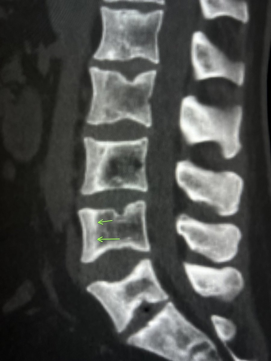 samrad77's tweet photo. Patchy sclerosis of the vertebral body with a “ruler straight” margin suggests bone infarction. 

In a patient with sickle cell disease. 

— today’s reporting list https://t.co/kDwucOJ6HG