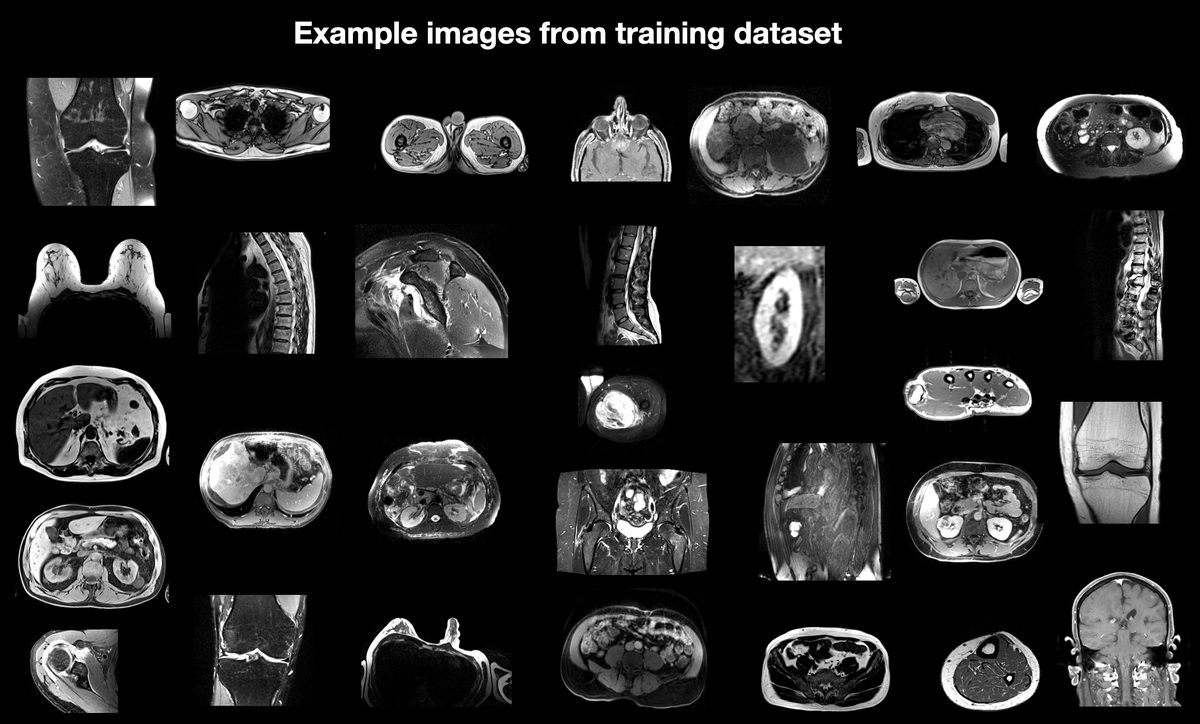 We added support for MR images to TotalSegmentator. 
It now segments 59 structures in MR images, regardless of sequence and contrast.

code: github.com/wasserth/Total…
paper: arxiv.org/abs/2405.19492
annotated dataset: doi.org/10.5281/zenodo…
online tool: totalsegmentator.com