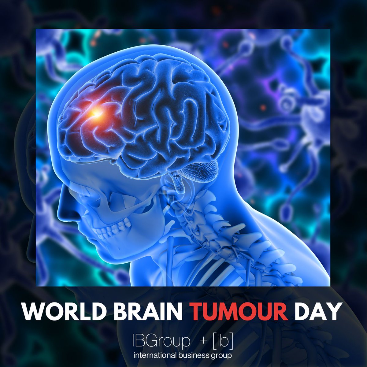 IBGroup_org's tweet photo. On World Brain Tumour Day, we stand together in solidarity with those battling this challenging condition. 

Let's raise awareness, offer support, and strive for breakthroughs in treatment. 💪

#WorldBrainTumourDay #IBGroup #withtogether #awareness https://t.co/gqja0zg8KR