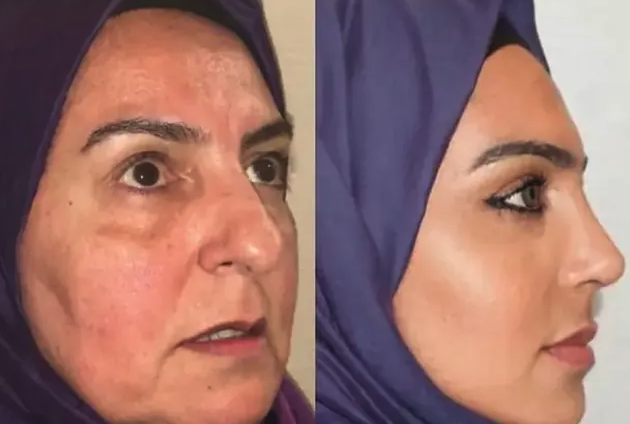 No decimos nada. Antes y después fake en una clínica estética extranjera. 

marca.com/tiramillas/act…