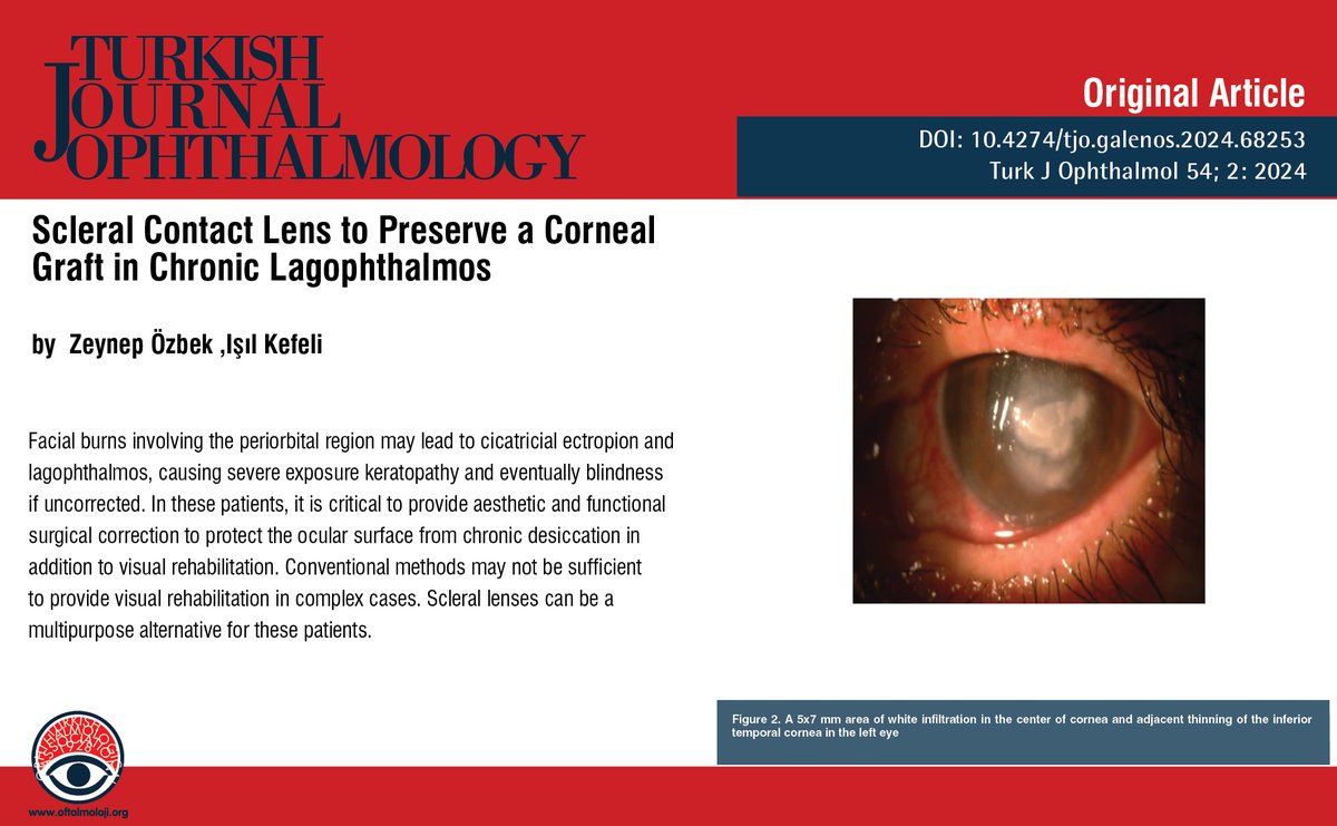 TurkJOphthalmol's tweet photo. Scleral Contact Lens to Preserve a Corneal Graft in Chronic Lagophthalmos
You can see the free full text of the research by Zeynep Özbek et al.
Link : https://t.co/kqP6OTqRXq
#Cicatricial #lagophthalmos #ectropion #exposurekeratopathy #facialburn #scleral #contactlens https://t.co/8JaM4R3JC9