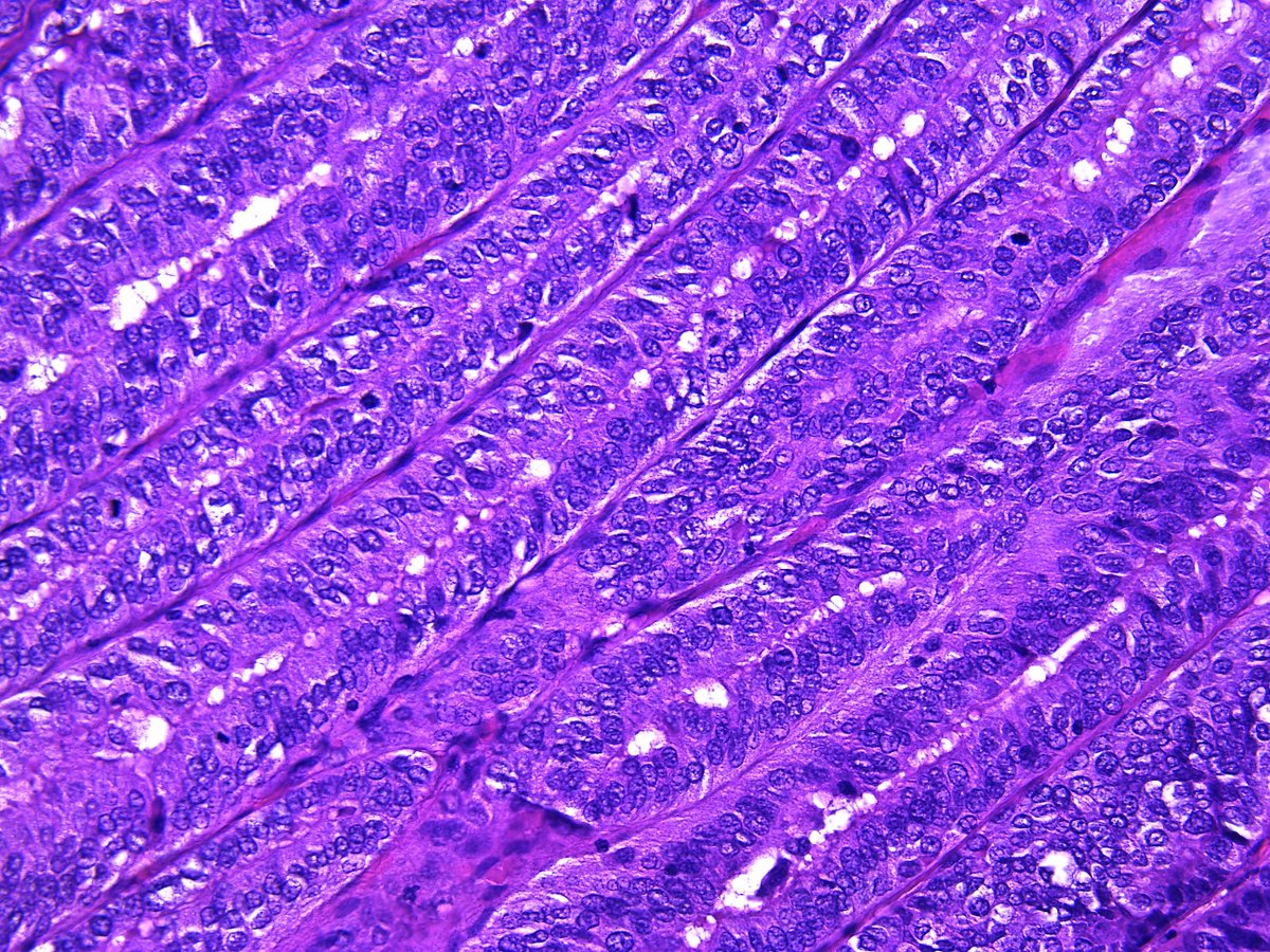 Pathology Walker@Auto Tweet Bot tweet media