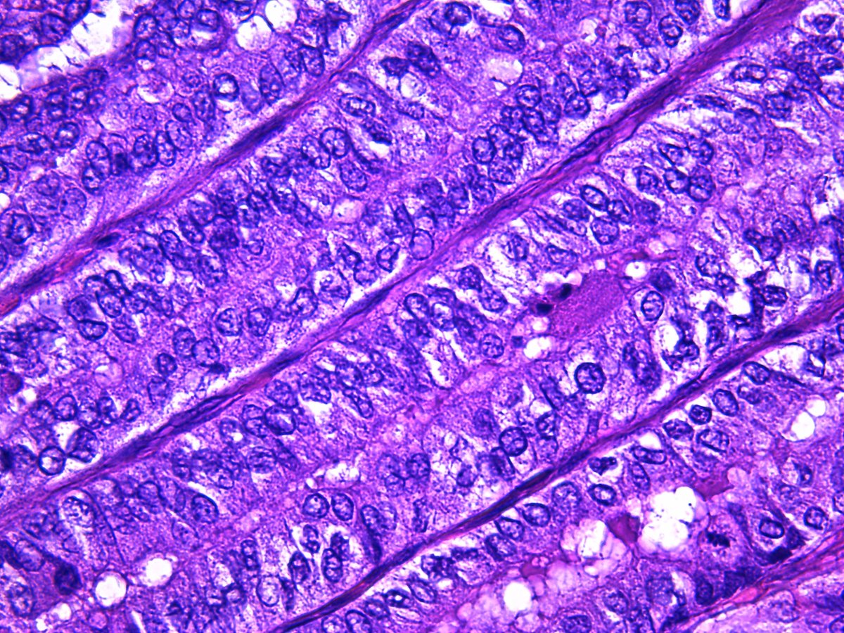 Pathology Walker@Auto Tweet Bot tweet media