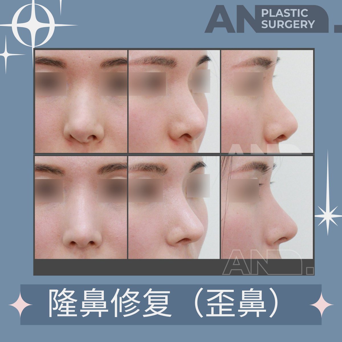 上/双眼皮手术| 李致一美容整形外科| 纽约华人整容诊所| 法拉盛，纽约, image size:1200x1200