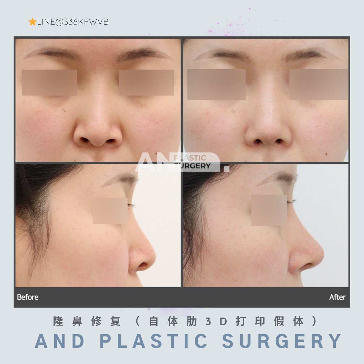 雙眼皮重修、開眼角、眼袋手術等等…… 想讓眼睛更明就有神但不知道哪裡才是眼整形首選嗎？ 誠意推薦韓國TOBE整形外科🙂 韓國TOBE整形外科, image size:1200x1200