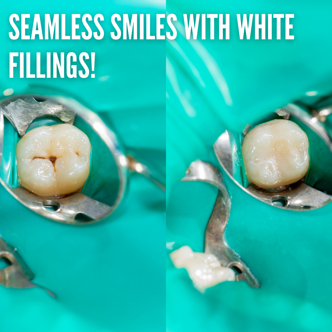 bureau_george's tweet photo. No more metal fillings to spoil your smile! Our white fillings blend perfectly with your natural teeth, giving you a flawless smile without compromising on strength and durability. Say hello to seamless smiles! 😁 #WhiteFillings #NaturalSmile Call now: 01473 257414 https://t.co/fHSBkFNC15