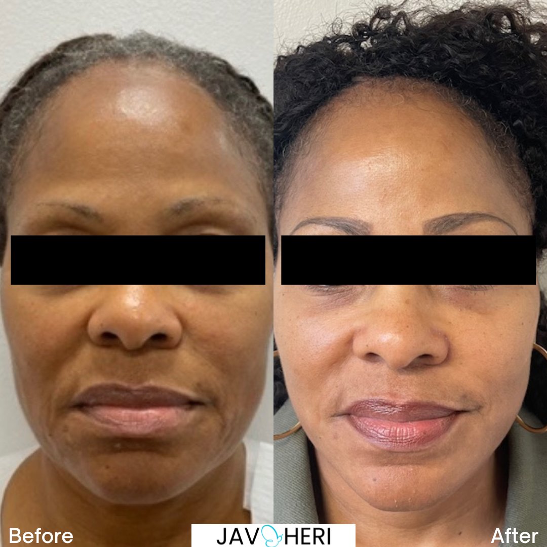 Shahin Javaheri, MD - Plastic Surgeon tweet media