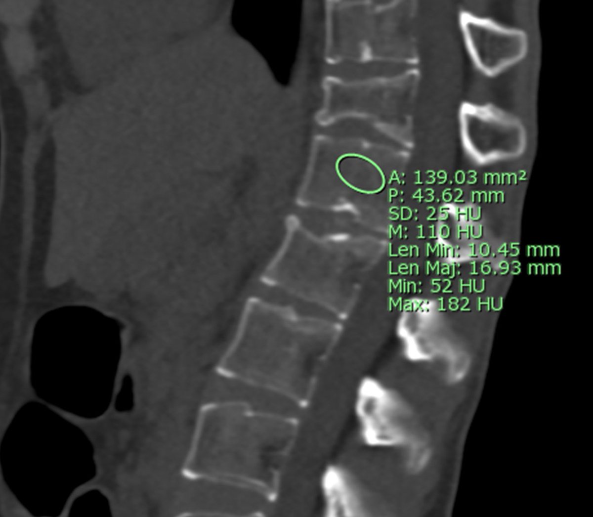 samrad77's tweet photo. L1 vertebral body attenuation, as measured on the sagittal plane of a CT abdomen, with a value less than 150 HU, highly suggests osteoporosis. Recommend the DEXA test for bone mineral densitometry! 

32-year-old with a CT attenuation of 110 HU and a compression fracture of T12. https://t.co/EJrxv2mKN1