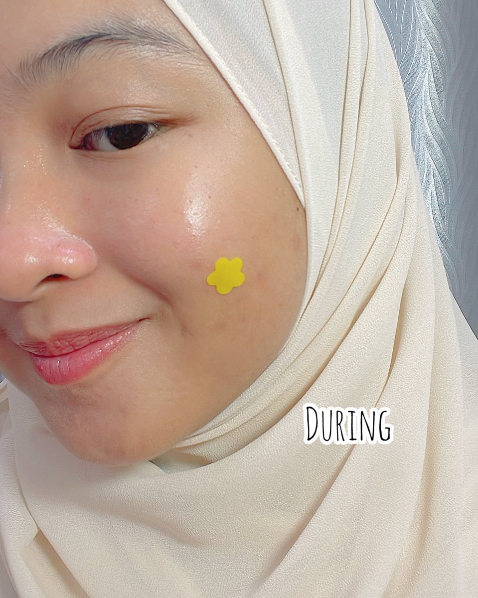 koyuki_rin's tweet photo. BACA SAMPAI HABIS👇🏻👇🏻👇🏻
Elok pulak timing seketul acne keluar untuk kite test Poppy Acne Patch by @tatagaltier @aushmilby  #tatagaltier #poppyflip💛🩷 https://t.co/KBaf3IHVgd