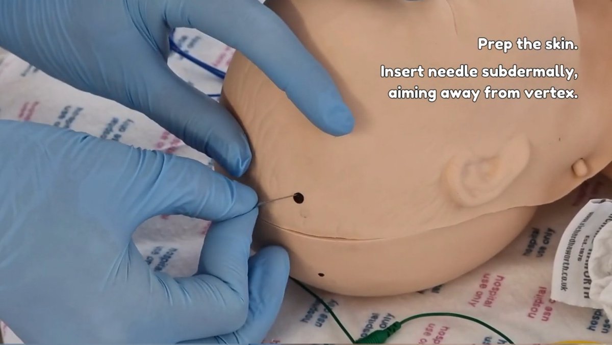 NeoSim Team (@neosimedrjms) on Twitter photo Our newest educational video drops today! Adam & <a href="/kstefkova/">Katarina Stefkova</a> talk us through Cerebral Function Monitoring (CFM) in neonates.
Our new CFM practical guideline is also now available on Belfast NICU's <a href="/EolasMedical/">Eolas Medical</a> space.
youtu.be/nll0LAaYuyU?si…
#NeoTwitter #NeoX #MedEd Our newest educational video drops today! Adam & <a href="/kstefkova/">Katarina Stefkova</a> talk us through Cerebral Function Monitoring (CFM) in neonates.
Our new CFM practical guideline is also now available on Belfast NICU's <a href="/EolasMedical/">Eolas Medical</a> space.
youtu.be/nll0LAaYuyU?si…
#NeoTwitter #NeoX #MedEd