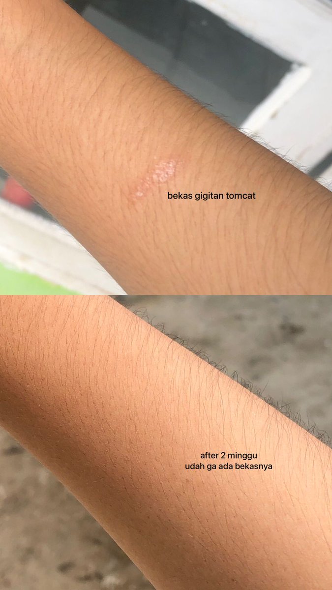 kiaaaaca's tweet photo. agak ga nyangka ternyata sabun ini beneran bisa ngilangin bekas luka akuuu dalam kurun waktu 2 mingguan, mana bikin kulit lebih cerahan jugaaa lohh✨
dann harganya kisaran 20ribu ajaaa🥹 https://t.co/XKAuj7QrGm