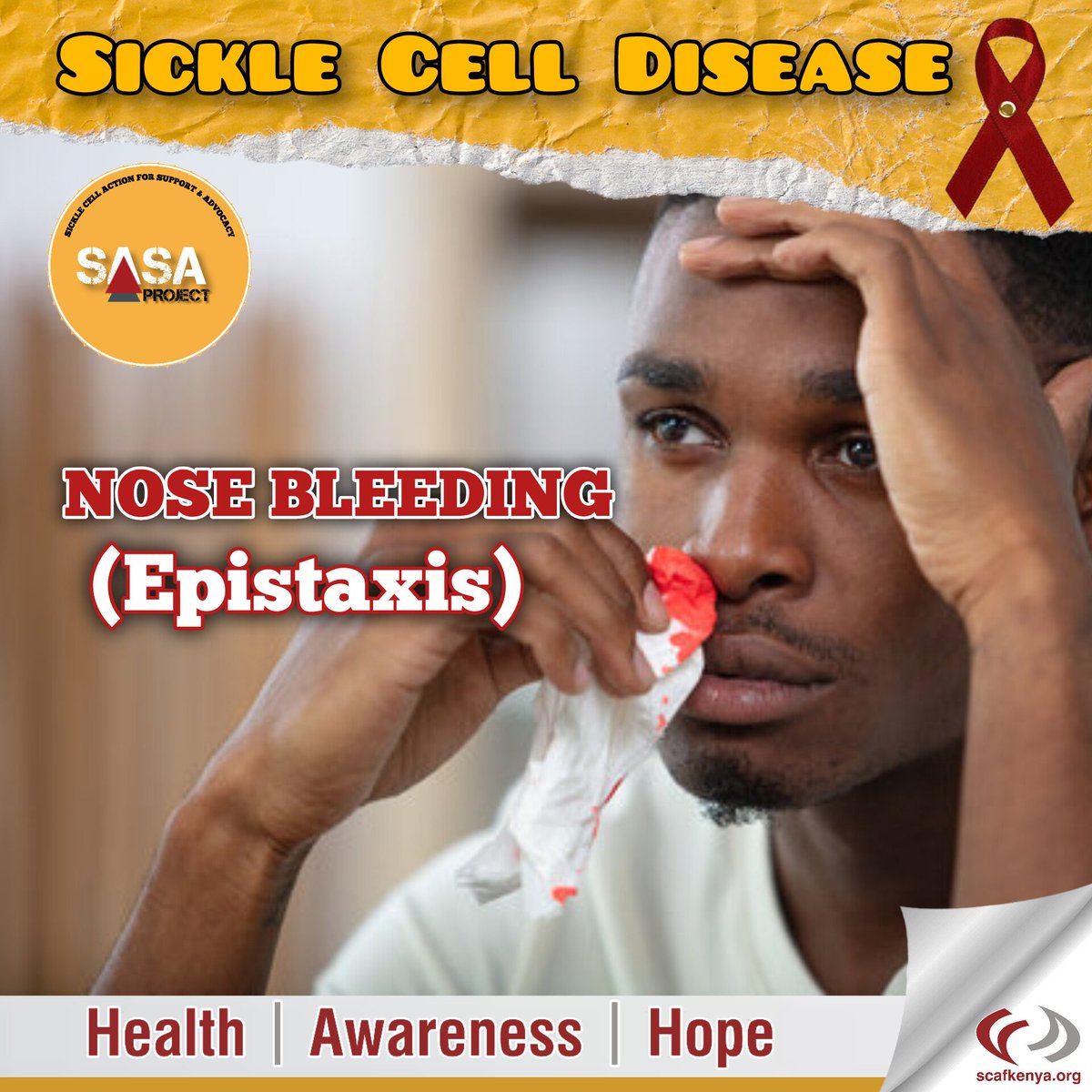 SCAFKenya's tweet image. 𝑵𝑶𝑺𝑬 𝑩𝑳𝑬𝑬𝑫 is one of the many common complications of 𝑺𝑰𝑪𝑲𝑳𝑬 𝑪𝑬𝑳𝑳 𝑫𝑰𝑺𝑬𝑨𝑺𝑬 even though it might happen more frequently it doesn't mean it should be considered 𝑵𝑶𝑹𝑴𝑨𝑳.

Read more here:
facebook.com/share/p/qnzzeN…

#SickleCellAwareness #SickleCellDisease